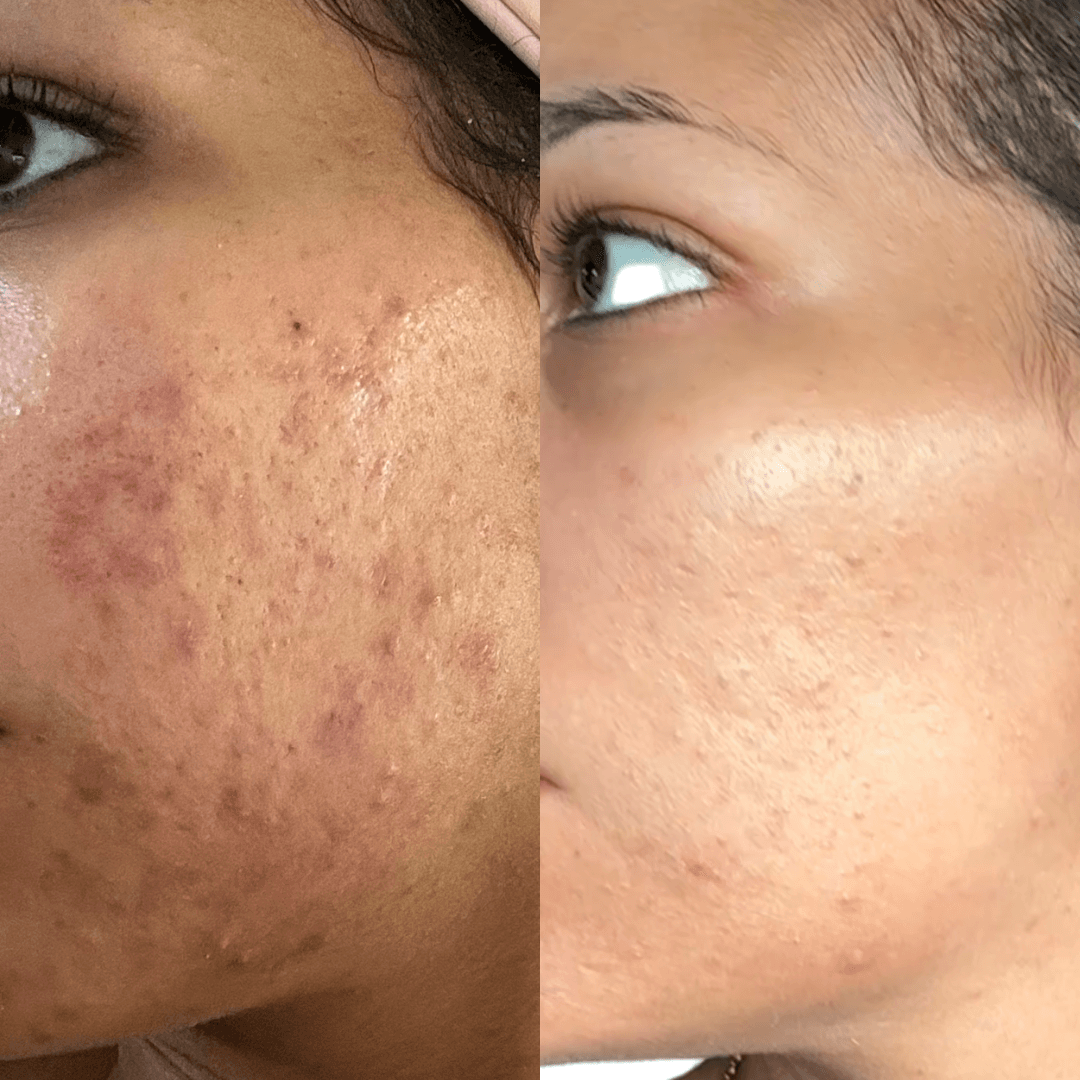 Skin care client results — acne improvement