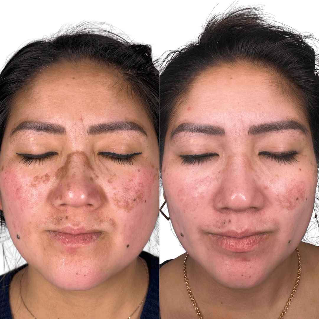 Skin care client results — hyperpigmentation improvement